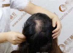 北京新生植发医院头顶加密植发8个月效果图,还前后对比照哦！