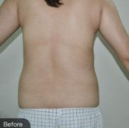 包头华美徐三明腰腹部吸脂一年后效果图，康康我的腰围细了多少!