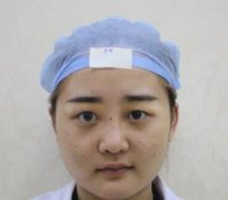 北京大学人民医院整形科双眼皮效果曝光!前后对比效果很自然
