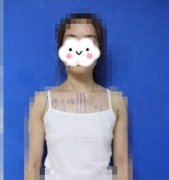 衢州市中医医院整形美容科隆胸要多少钱?新版价格表和效果照片分享
