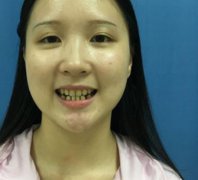 徐州医科大学附属医院口腔科整牙案例和效果对比图分享