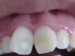 第四军医大学口腔医院牙齿矫正案例分享，放心微笑不惧尴尬