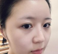 北京伊芙丽格切开双眼皮术后两个月效果图分享，附医生推荐