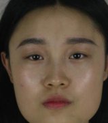 北京八大处靳小雷下颌角磨骨案例分享：从20岁开始变美了！