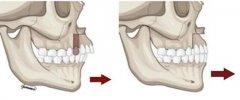 天包地嘴型是一定得正颌吗?正颌手术会不会特别恐怖!