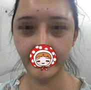 郑州集美刘德辉祛眼袋+自体脂肪填充案例 面部年轻一步逆袭
