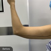 沈阳军区总医院整形美容科手臂抽脂前后对比照-恢复经历过程