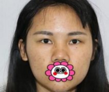台州市立医院整形外科鲁继增医生做鼻子案例~恢复经历分享