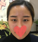 长沙爱思特张娇娇医生的双眼皮案例展示：看韩式双眼皮的自然效果！