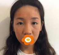 北京八大处隆鼻+双眼皮案例分享，术后效果惊艳！