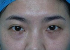 据了解：我可能是韩国曹仁昌眼部修复实录案例里较自然的,眼睑修复+提肌分享