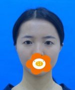 谢燕燕在济南海峡我做的双眼皮案例全程恢复记录，附果对比图